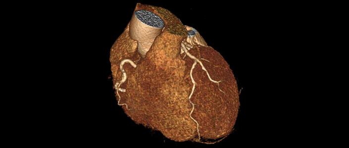 一項硬科技，讓CTA冠脈診斷方式徹底顛覆